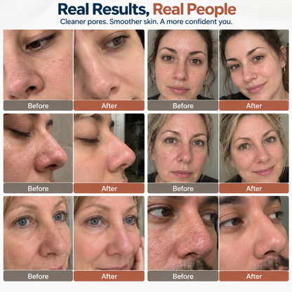 ✨ Electric Pore Vacuum Cleaner – Stop Squeezing 🔥 Start Lifting Visible Pore Buildup