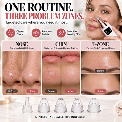✨ Electric Pore Vacuum Cleaner – Stop Squeezing 🔥 Start Lifting Visible Pore Buildup